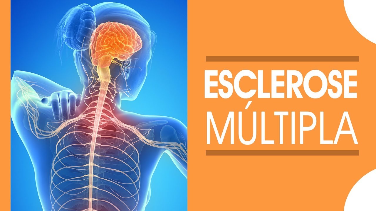 A Esclerose Múltipla (EM) é uma doença neurológica, crônica.